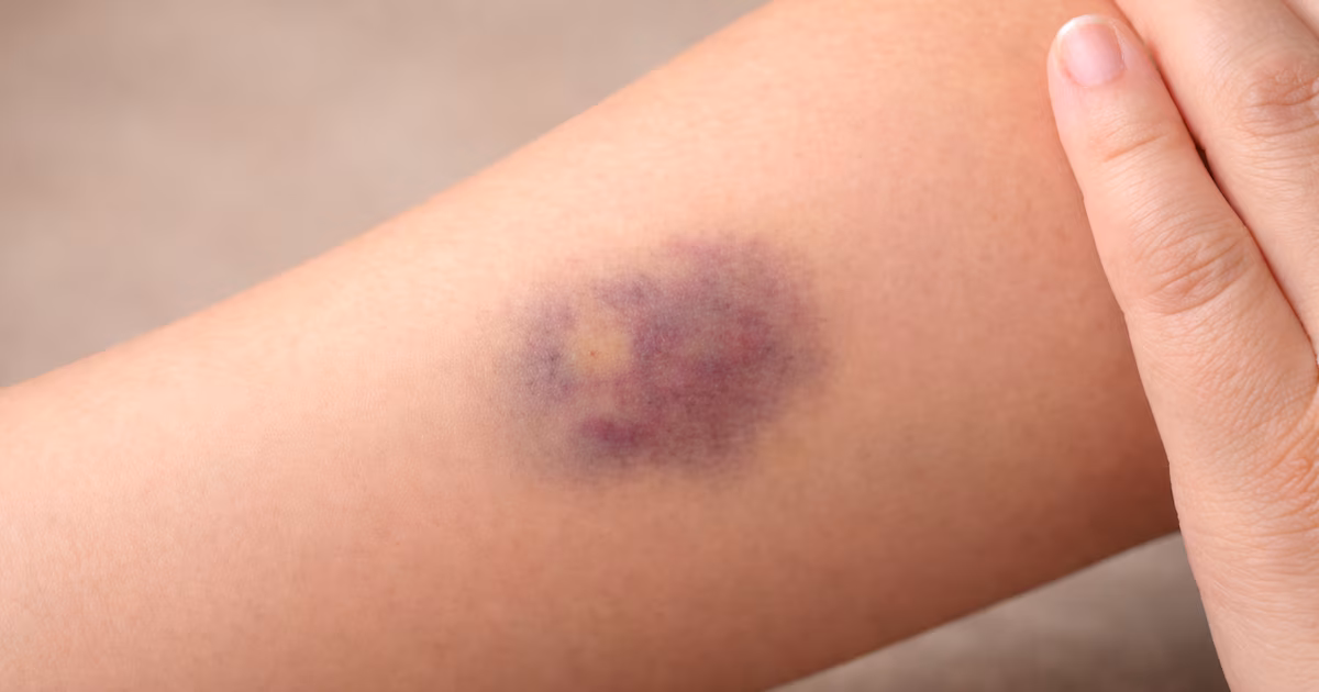 Por qué la aparición frecuente de hematomas puede indicar una deficiencia de vitamina C