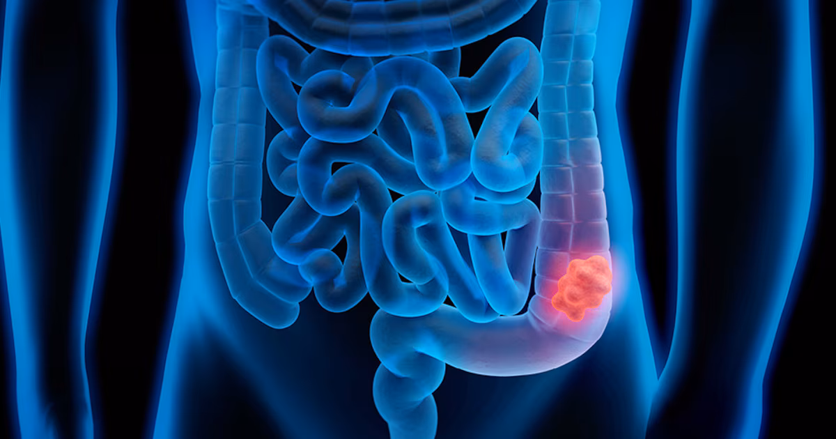 El cáncer colorrectal se convirtió en la principal causa de muerte oncológica en menores de 50 años en EE.UU.