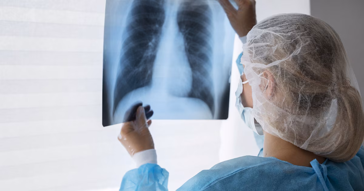 Neumonía atípica: en qué se diferencia de la variante común y por qué puede pasar desapercibida, según expertos