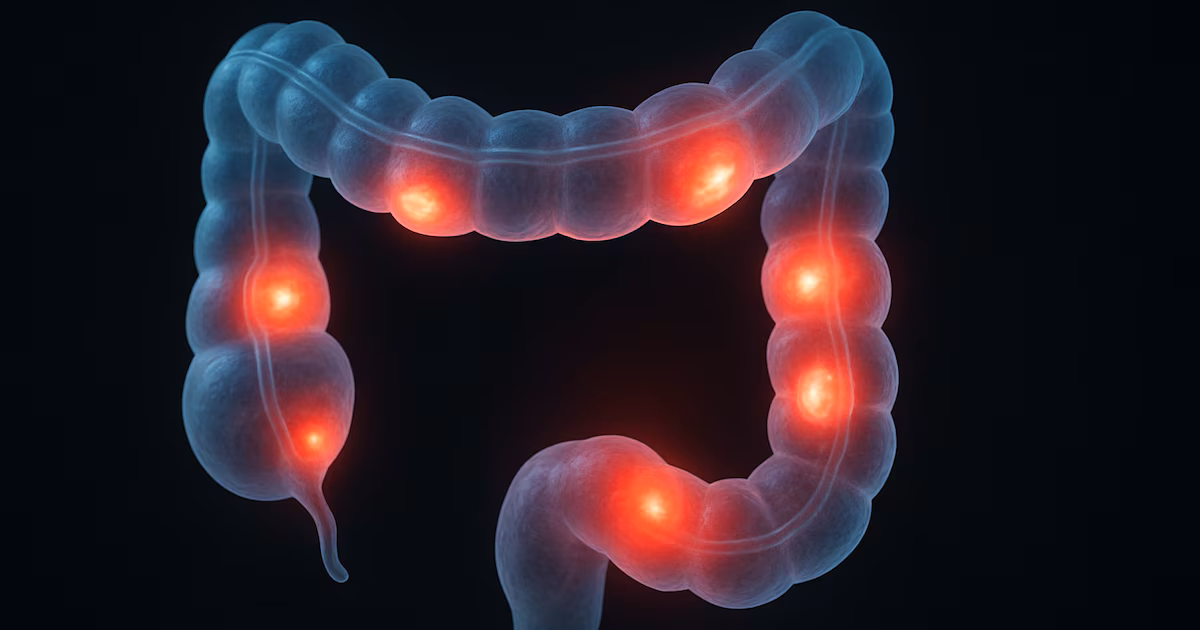 Limitar las calorías cinco días al mes podría mejorar los síntomas en la enfermedad de Crohn, afirma un estudio