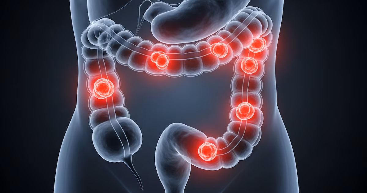 Pólipos de colon: tipos, señales de advertencia y cómo prevenir el cáncer colorrectal