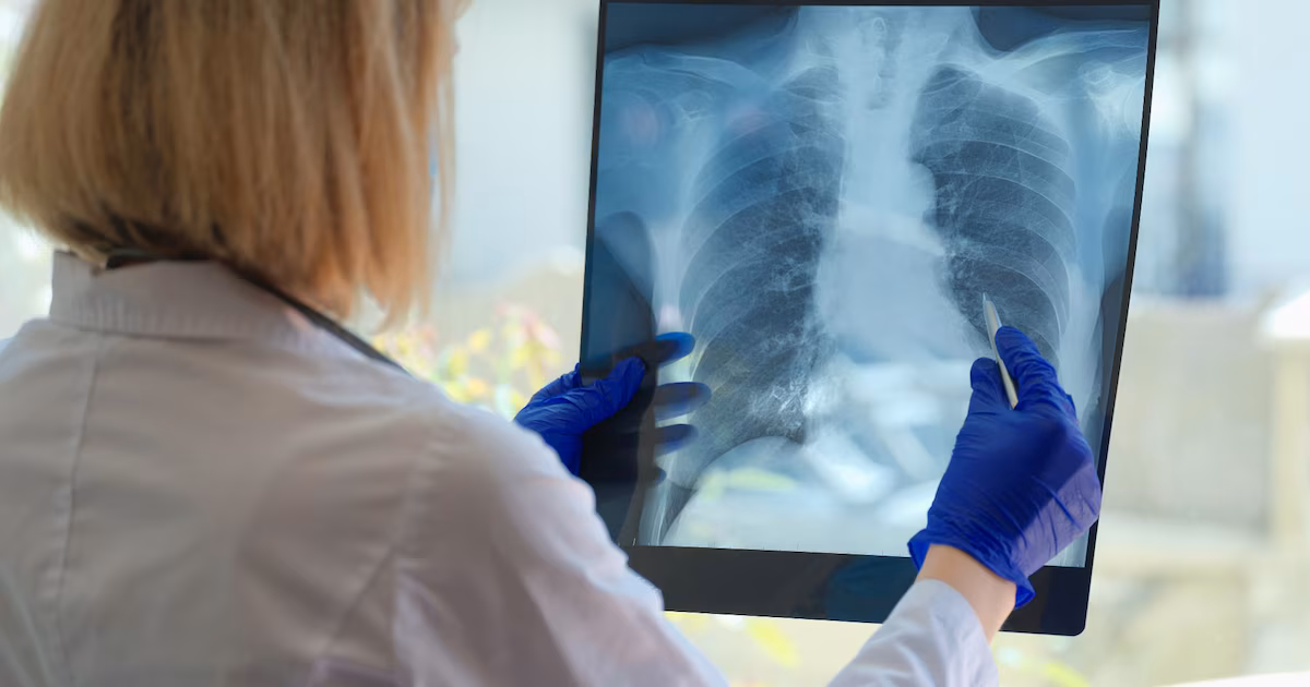 Tratar el cáncer de pulmón por la mañana duplica la respuesta de la inmunoterapia