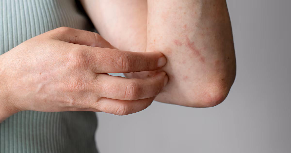 Dermatitis atópica: cómo prevenir los brotes de eccema y qué hábitos pueden ayudar a controlar la piel