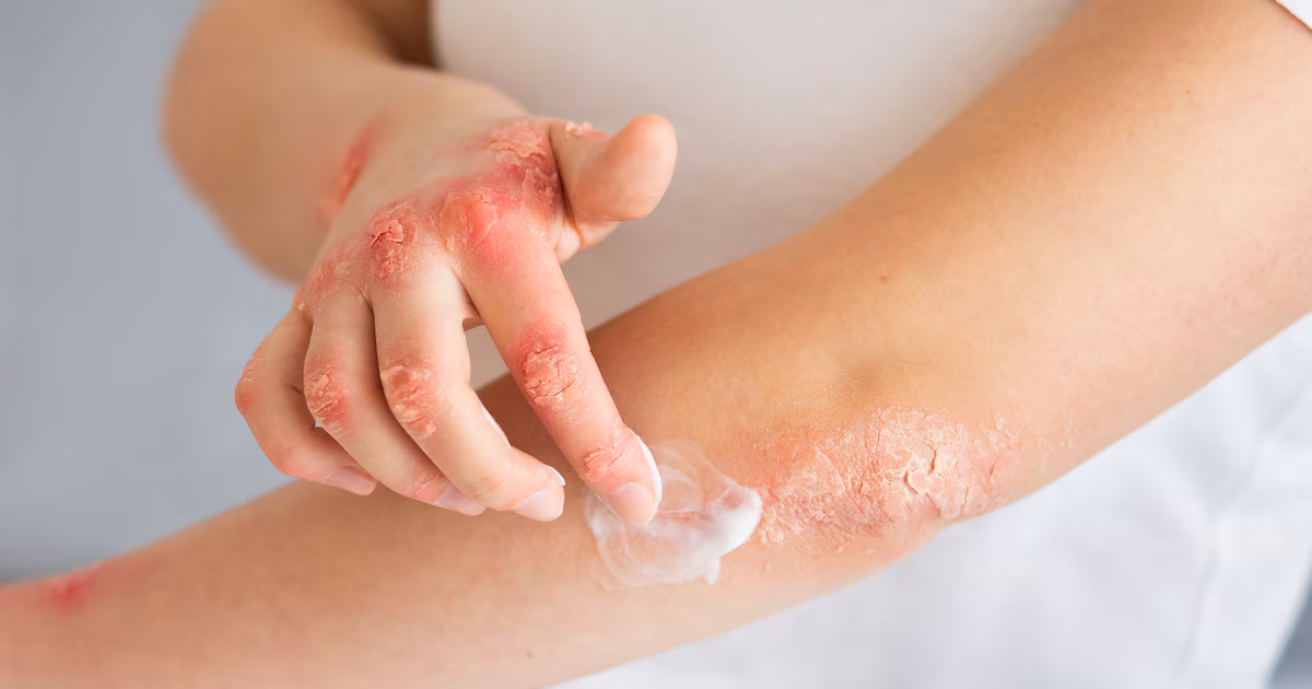 La urticaria crónica es más que un simple problema de la piel: cómo afecta el sueño, la ansiedad y la vida social