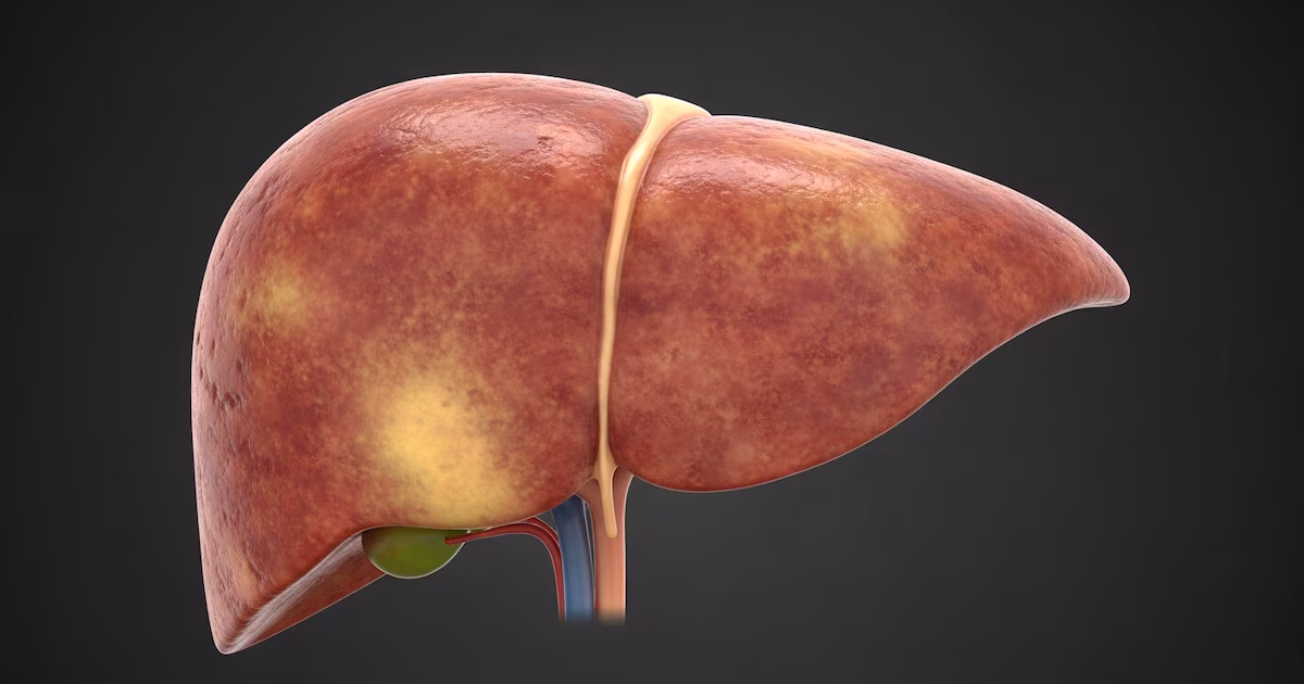 Enfermedad del hígado graso: cómo el consumo de café afecta la fibrosis hepática