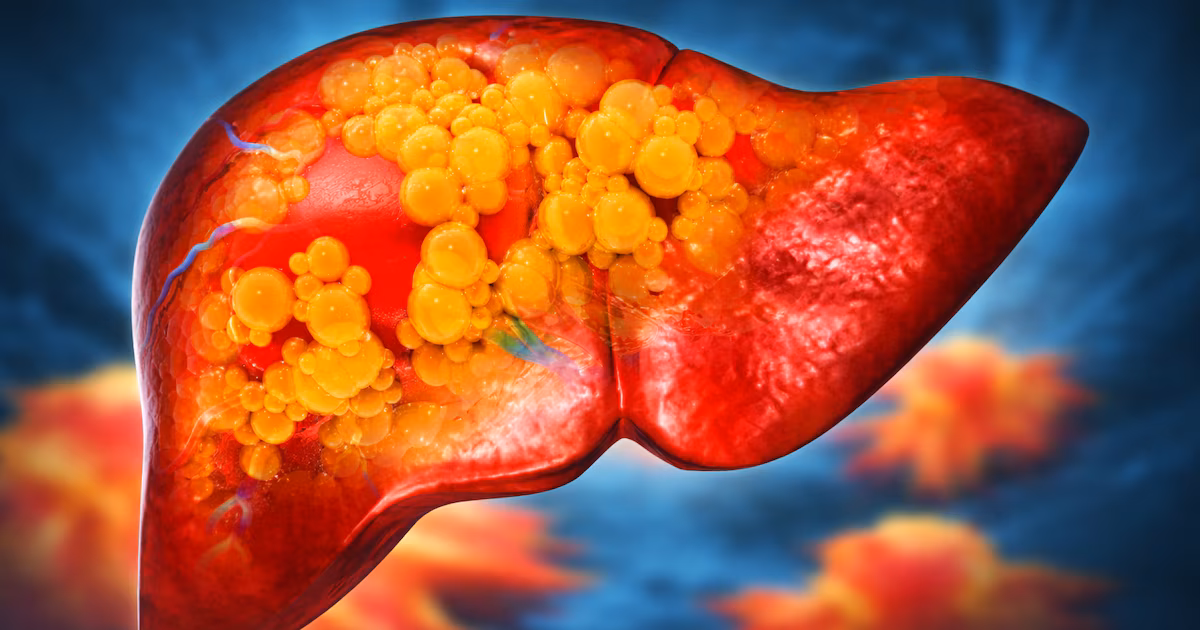 Un estudio mundial advierte que la prevalencia de la enfermedad del hígado graso aumentará un 42% en 2050