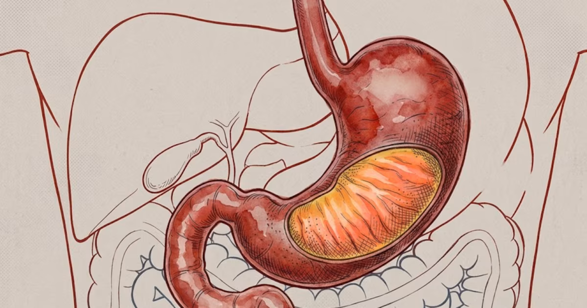 6 síntomas del cáncer gástrico temprano