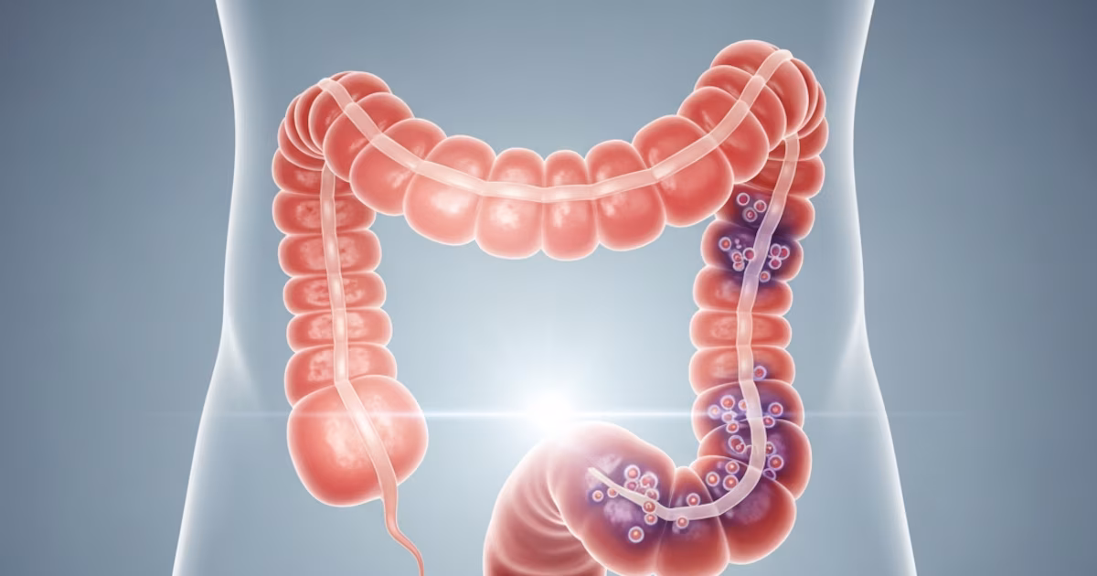 Por qué las personas menores de 50 años tienen tasas más altas de cáncer colorrectal: todo lo que necesita saber para prevenir el cáncer colorrectal