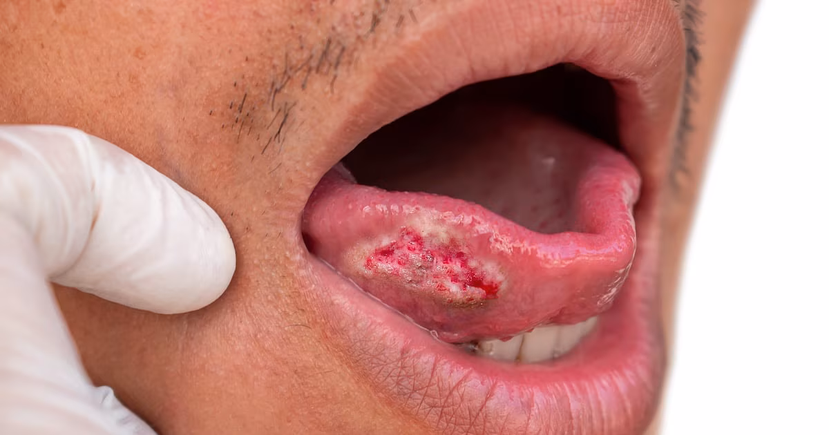 Una nueva prueba de cepillado de dientes de alta precisión detecta el cáncer bucal en una hora