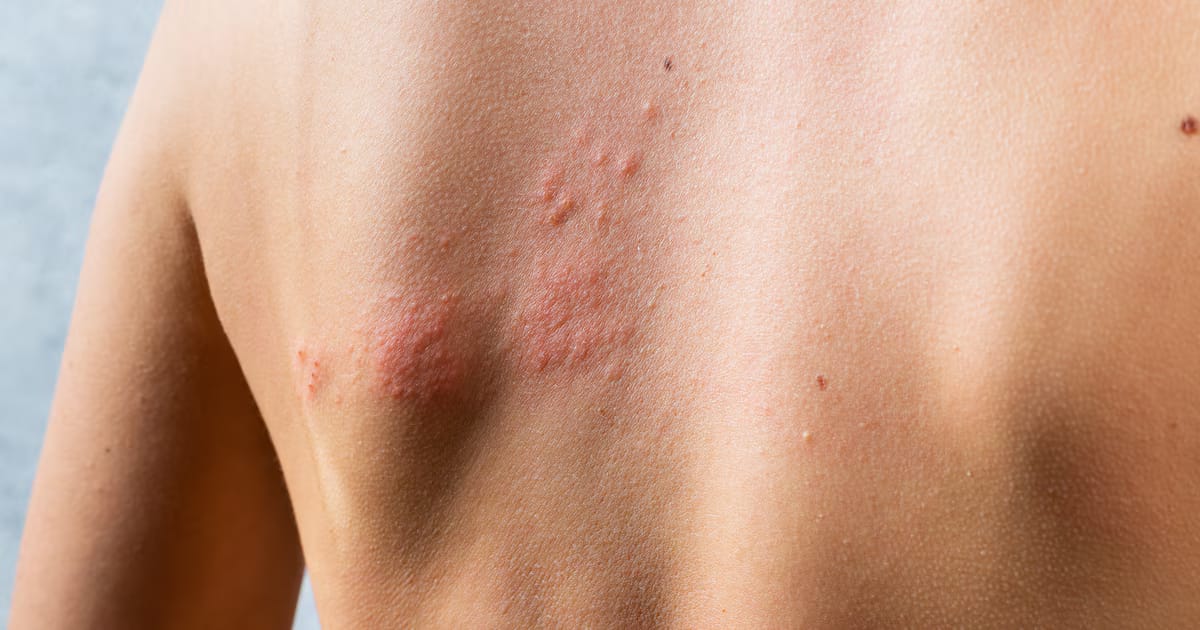 Herpes zóster: ¿Cuáles son los primeros síntomas que la mayoría de los pacientes no reconocen?