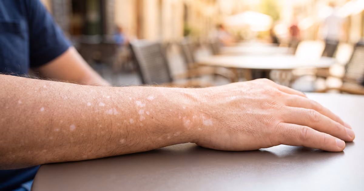¿Por qué aparecen manchas blancas en brazos y piernas?